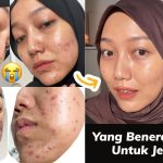 solusi-jerawat-yang-terbukti-efektif-sebuah-analisis-dermatologis-komprehensif