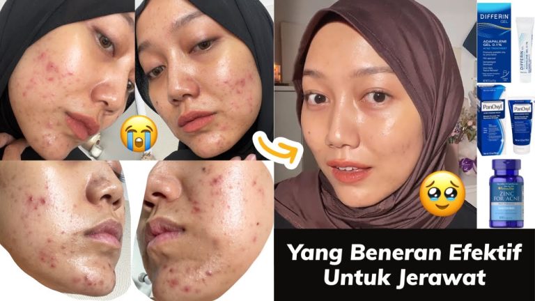 solusi-jerawat-yang-terbukti-efektif-sebuah-analisis-dermatologis-komprehensif