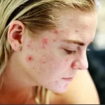 waspada-ini-dia-makanan-pemicu-jerawat-yang-wajib-anda-hindari