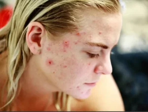 waspada-ini-dia-makanan-pemicu-jerawat-yang-wajib-anda-hindari